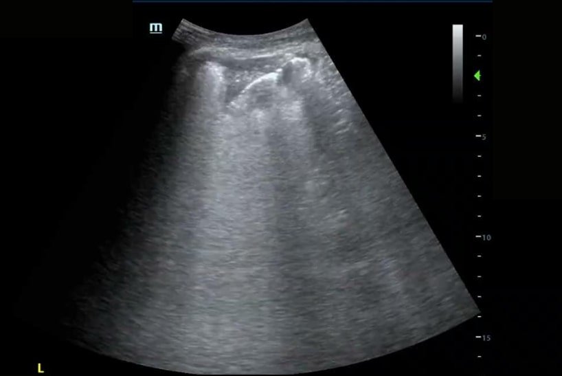 Navigating Cold and Flu Season: The Power of POCUS in Respiratory Diagnosis | Dec 2023 Newsletter 14 unnamed 36